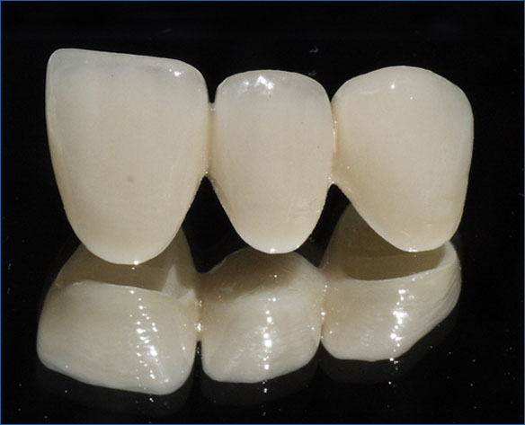 Răng sứ cercon cũng là một loại răng giả có tác dụng nhằm thay thế những răng sinh lý