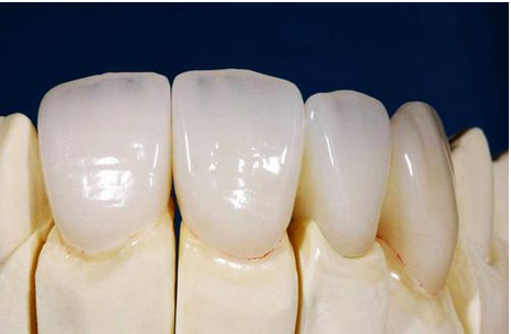 Bọc răng sứ Cercon cho răng hàm