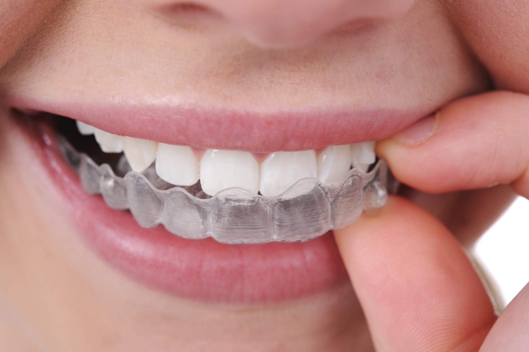 Niềng răng invisalign