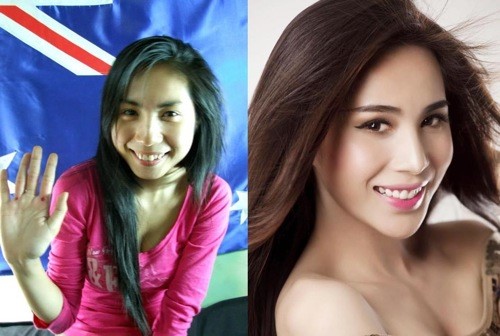 Niềng răng đẹp cỡ nào? - Thủy Tiên