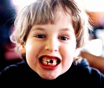 Bệnh sâu răng không còn là nỗi lo (1)