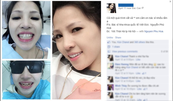 Bệnh nhân làm răng sứ tại Nha Khoa Quốc tế Việt Đức