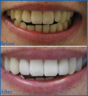 Tẩy trắng răng không ê buốt