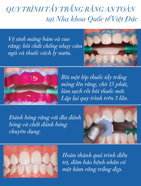 Tẩy trắng răng không ê buốt 1