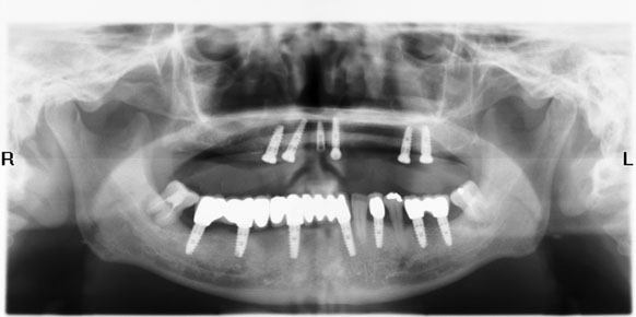 Chụp X-quang răng