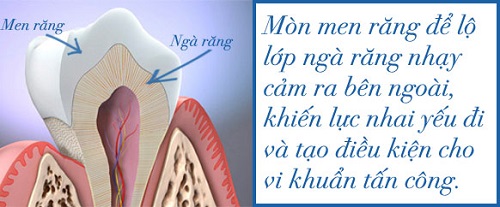 Điều trị mòn răng 1