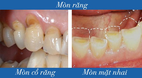 Điều trị mòn răng