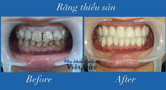 Lý do bạn nên bọc răng sứ thẩm mỹ