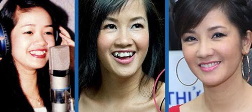 co-nen-nieng-rang-invisalign