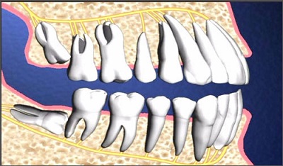 Mọc răng khôn ở hàm dưới thì phải làm gì? Mọc răng khôn ở hàm dưới thì phải làm gì?