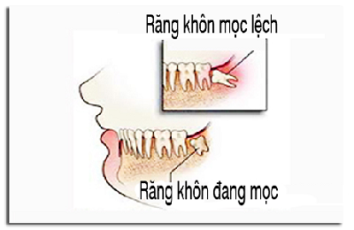 Nếu đau quá thì bạn nên đi khám bác sĩ nha khoa để không làm ảnh hưởng đến cuộc sống hàng ngày