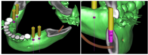 quy-trinh-cay-ghep-implant-3d-e1408192073319