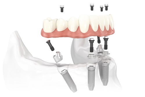 Những loại Implant phổ biến nhất hiện nay