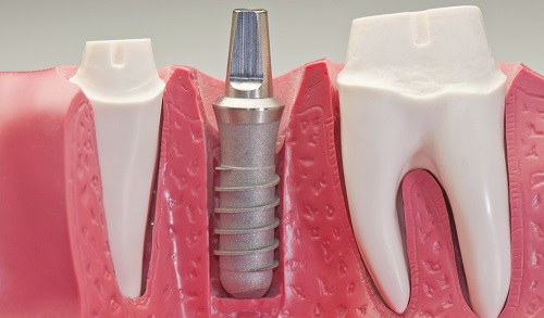 Implant DIO được làm từ Titanium