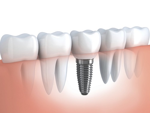 Implant Aesthetica