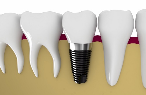 Những yếu tố nào quyết định sự thành công của ca cấy ghép implant?