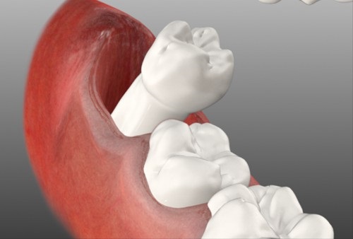 Cách xử lý khi nướu bị sưng do mọc răng khôn