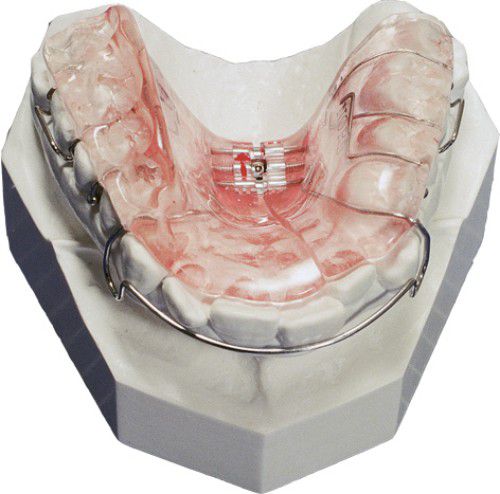 nieng-rang-mac-cai-kim-loai-1