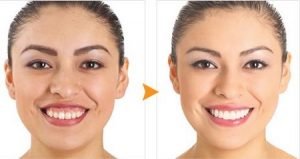 nieng-rang-cuoi-ho-loi