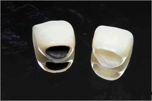 răng sứ kim loại Ni – Cr là gì