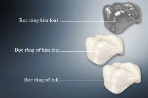 Lý do bạn chọn răng sứ kim loại Cr-Ni