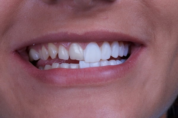 Những lợi ích của việc bọc răng sứ thẩm mỹ