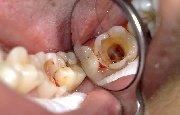 Cách khắc phục răng số 7 bị sâu