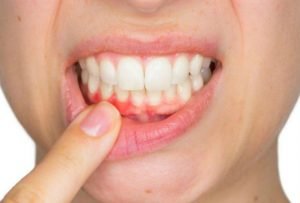 Nguyên nhân và ảnh hưởng của răng cửa bị sâu