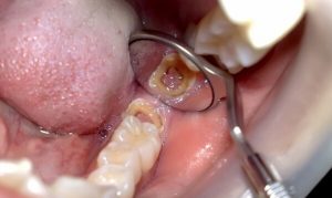 Chi phí điều trị sâu răng hiện nay