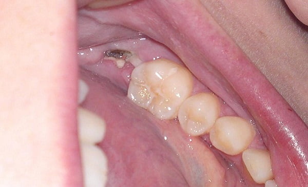 Giai đoạn răng hàm sâu bị vỡ