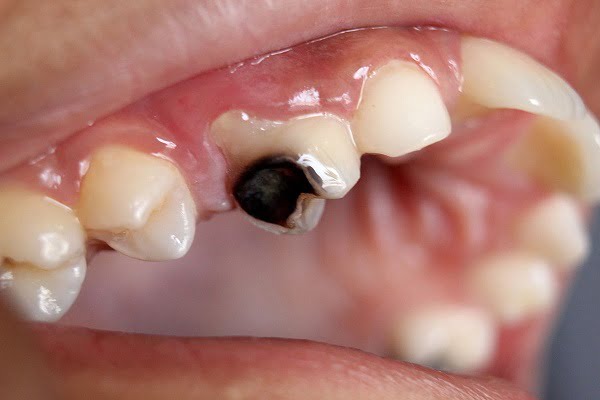 Nguyên nhân, tác hại răng sâu đen