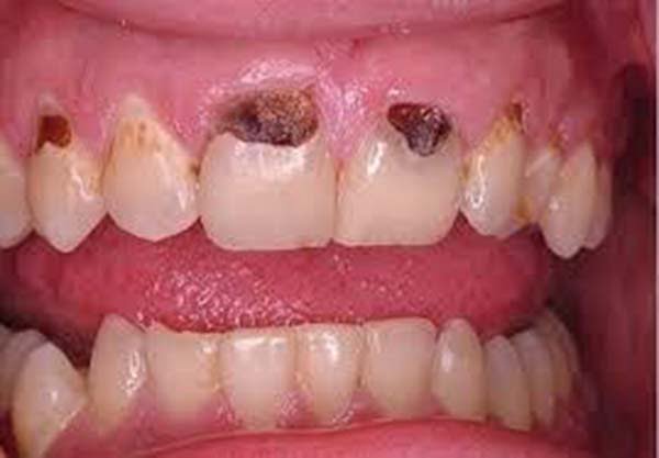 Lỗ răng sâu trên bề mặt răng cửa gây mất thẩm mỹ
