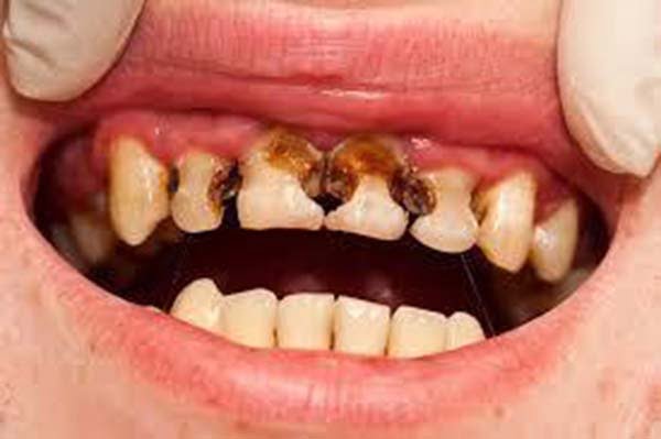 Răng cửa đã bị sâu gần hết thân răng.