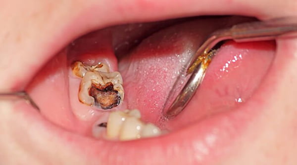 Lỗ sâu khá lớn trên bề mặt nhai của răng