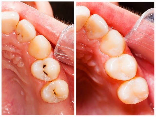 Điều trị răng sâu lồi thịt bằng cách nào hiệu quả nhất