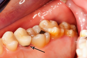 Phần cao răng tích tụ ở chân răng cũng sẽ trở thành nguyên nhân gây sâu chân răng