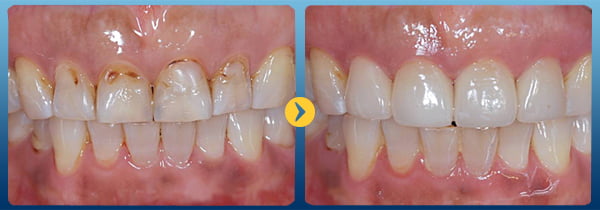 Trám răng được sử dụng ở giai đoạn sâu răng đã phát triển