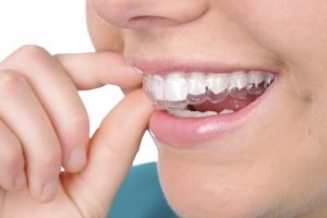 Khả năng nắn chỉnh răng của dụng cụ niềng tại nhà cực kỳ linh hoạt